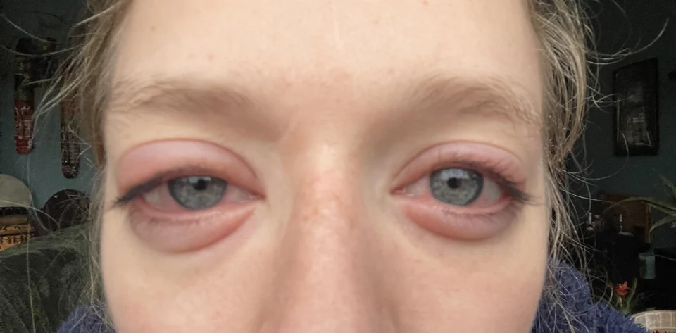 how long can eyelash tinting damage your eyes