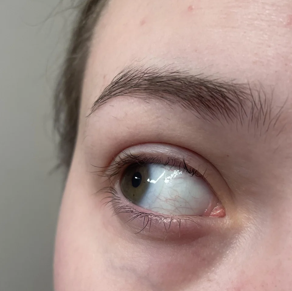 8-week lash recovery timeline showing progression from damaged to healthy lashes with treatment protocols for each phase